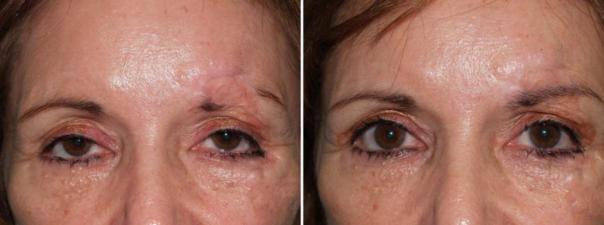 Eyebrow Transplantation before and after photos in Miami, FL, Patient 16715