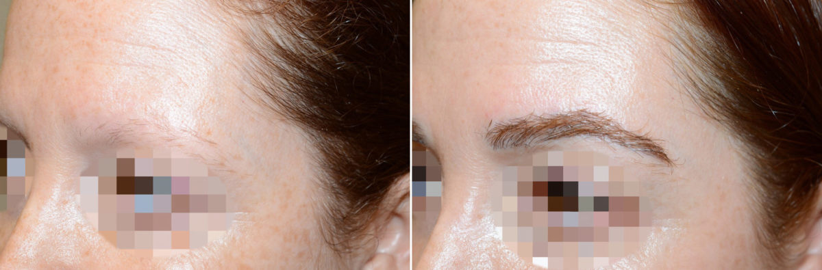 Eyebrow Transplantation before and after photos in Miami, FL, Patient 16718