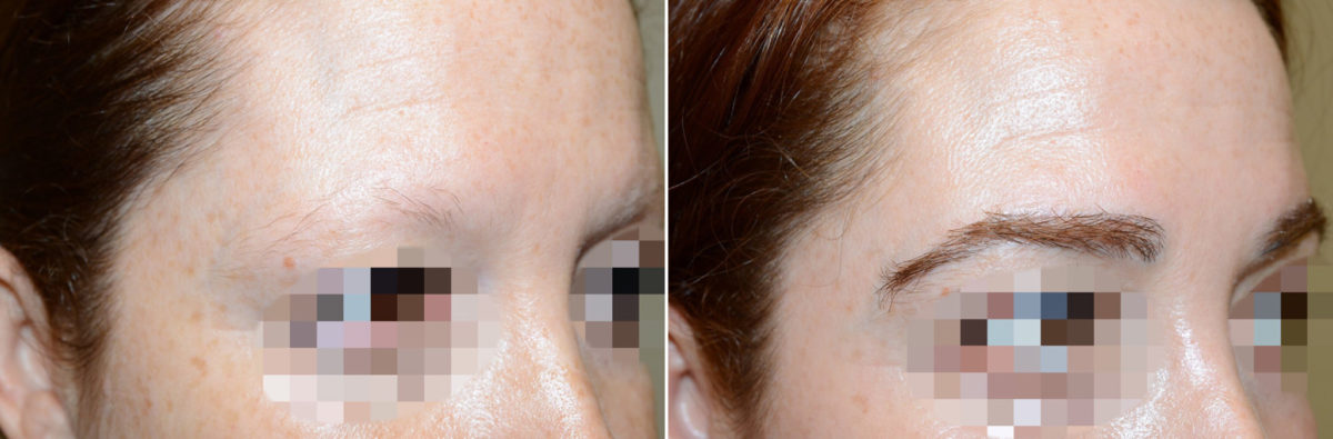 Eyebrow Transplantation before and after photos in Miami, FL, Patient 16718