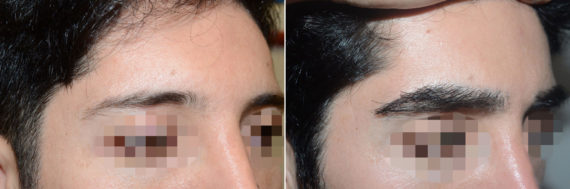 Eyebrow Transplantation before and after photos in Miami, FL, Patient 16725