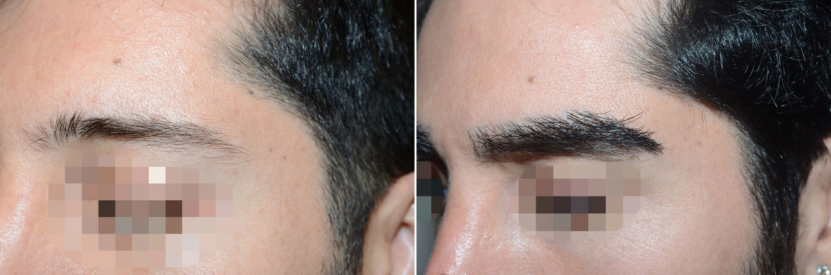 Eyebrow Transplantation before and after photos in Miami, FL, Patient 16725