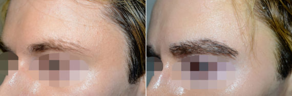 Eyebrow Transplantation before and after photos in Miami, FL, Patient 16732