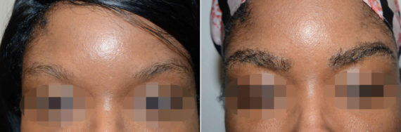 Eyebrow Transplantation before and after photos in Miami, FL, Patient 16739