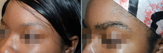 Eyebrow Transplantation before and after photos in Miami, FL, Patient 16739