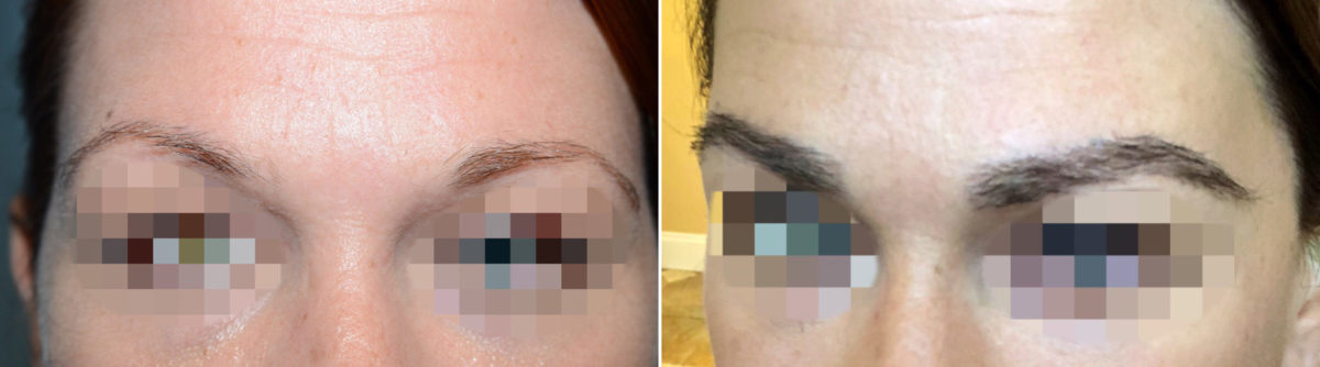 Eyebrow Transplantation before and after photos in Miami, FL, Patient 16747
