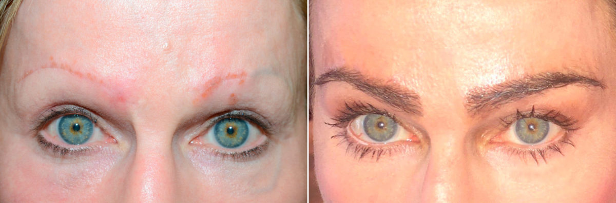 Eyebrow Transplantation before and after photos in Miami, FL, Patient 16750
