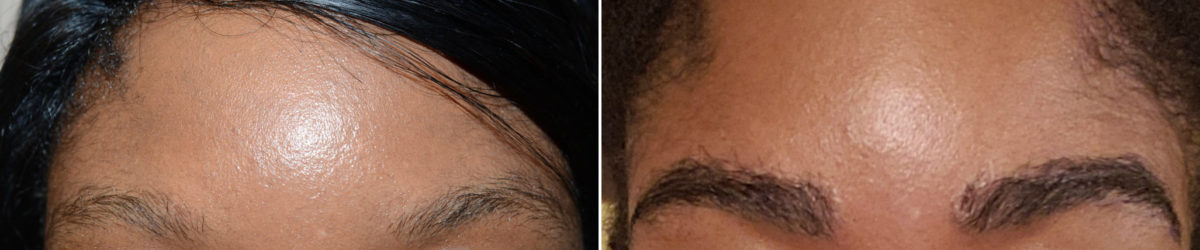 Eyebrow Transplantation before and after photos in Miami, FL, Patient 16757