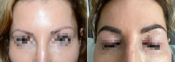 Eyebrow Transplantation before and after photos in Miami, FL, Patient 16767