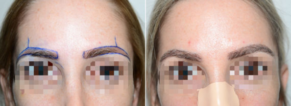 Eyebrow Transplantation before and after photos in Miami, FL, Patient 16770