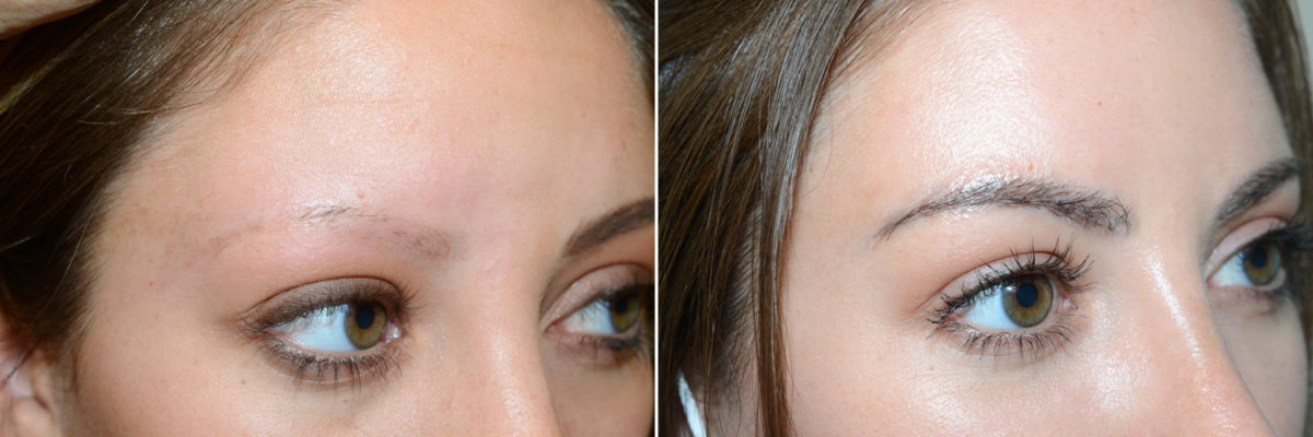 Eyebrow Transplantation before and after photos in Miami, FL, Patient 16773