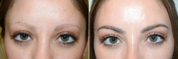 Eyebrow Transplantation before and after photos in Miami, FL, Patient 16773