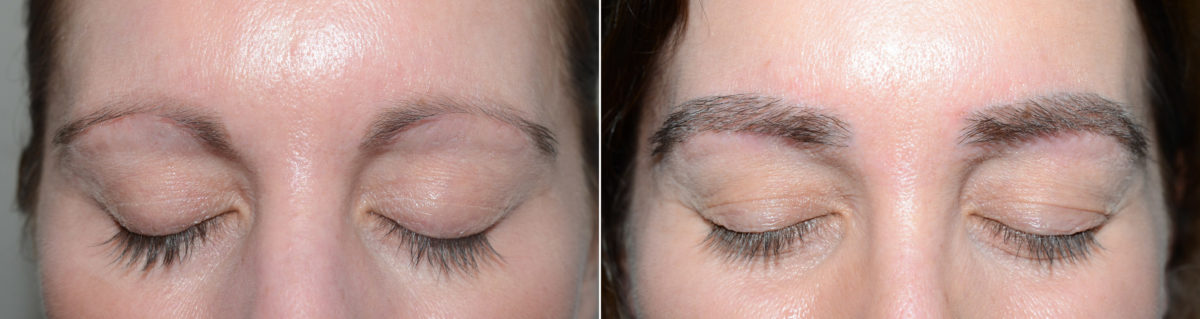 Eyebrow Transplantation before and after photos in Miami, FL, Patient 18046