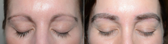 Eyebrow Transplantation before and after photos in Miami, FL, Patient 18046