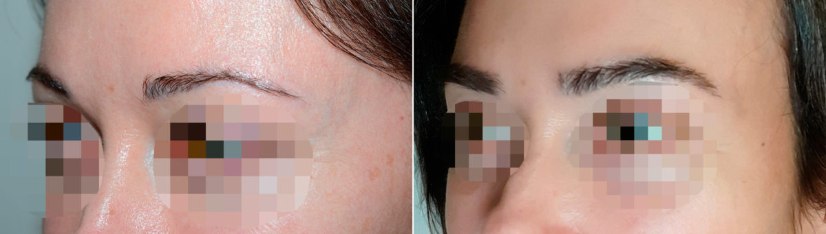 Eyebrow Transplantation before and after photos in Miami, FL, Patient 18079