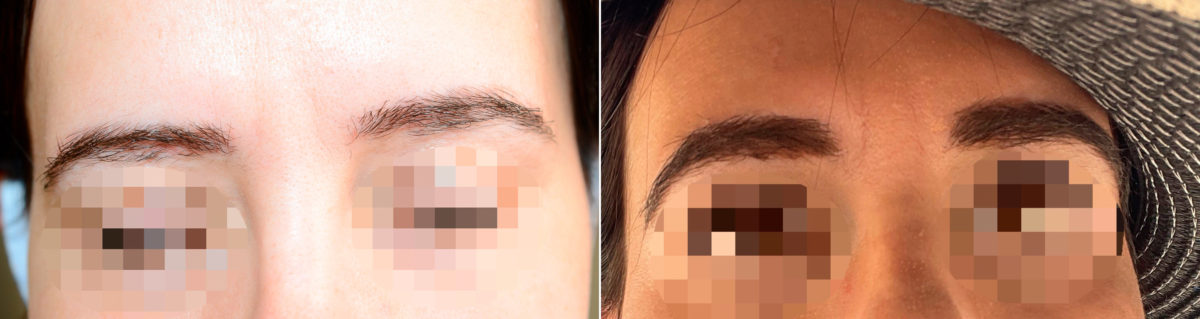 Eyebrow Transplantation before and after photos in Miami, FL, Patient 18089