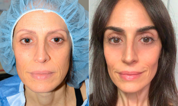 Eyebrow Transplantation before and after photos in Miami, FL