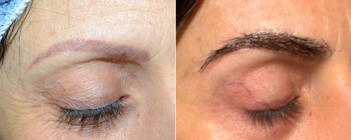 Eyebrow Transplantation before and after photos in Miami, FL, Patient 18105