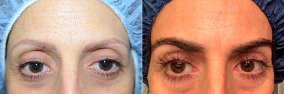 Eyebrow Transplantation before and after photos in Miami, FL, Patient 18105