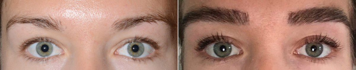 Eyebrow Transplantation before and after photos in Miami, FL, Patient 18116