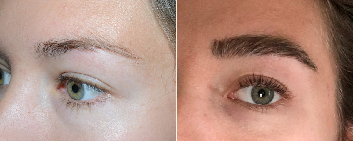Eyebrow Transplantation before and after photos in Miami, FL, Patient 18116