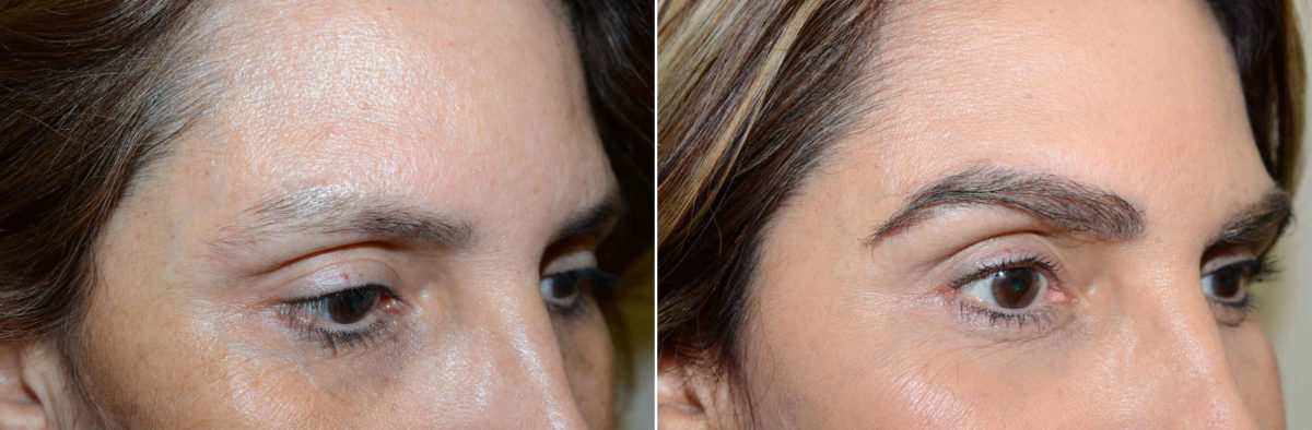 Eyebrow Transplantation before and after photos in Miami, FL, Patient 18130