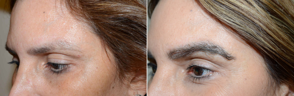 Eyebrow Transplantation before and after photos in Miami, FL, Patient 18130