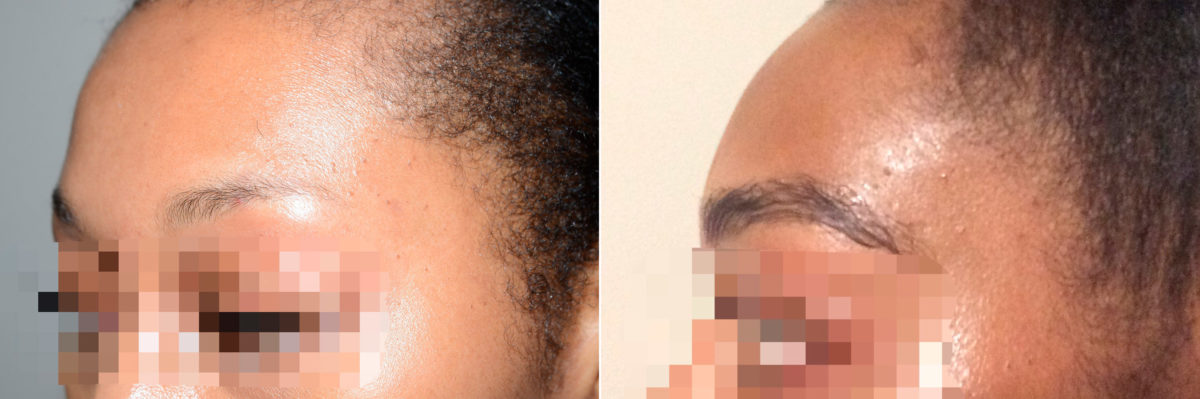 Eyebrow Transplantation before and after photos in Miami, FL, Patient 18141