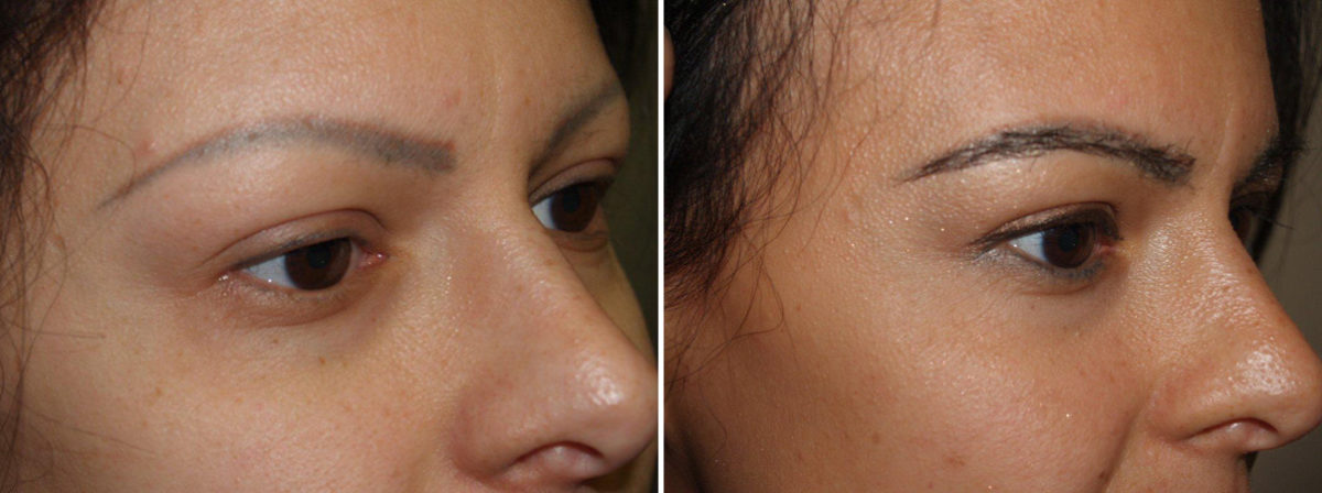 Eyebrow Transplantation before and after photos in Miami, FL, Patient 15727