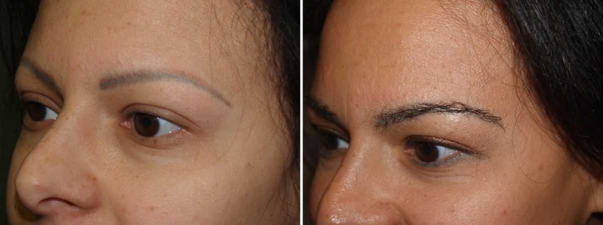 Eyebrow Transplantation before and after photos in Miami, FL, Patient 15727