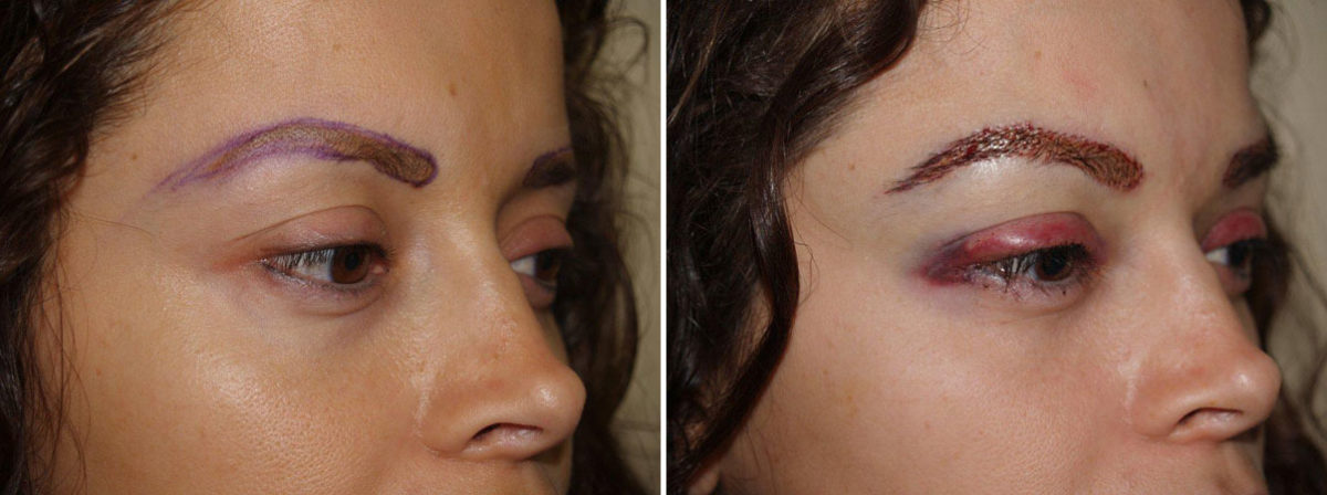 Eyebrow Transplantation before and after photos in Miami, FL, Patient 16125