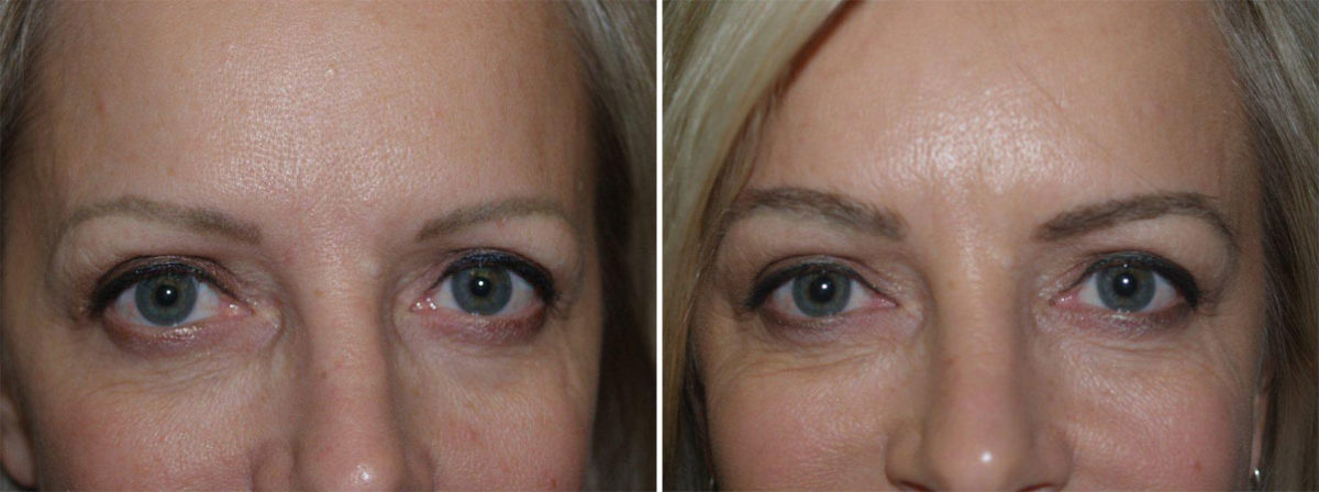 Eyebrow Transplantation before and after photos in Miami, FL, Patient 16335