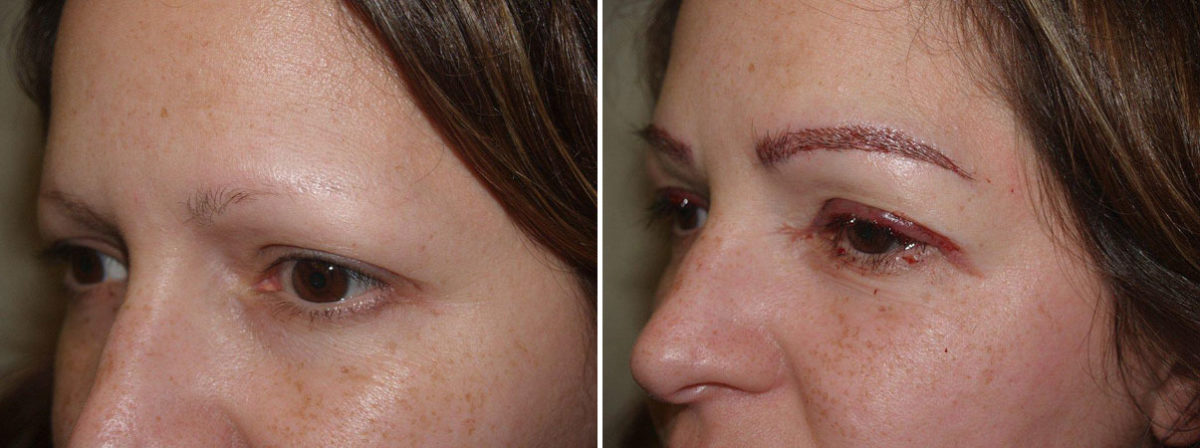 Eyebrow Transplantation before and after photos in Miami, FL, Patient 16390