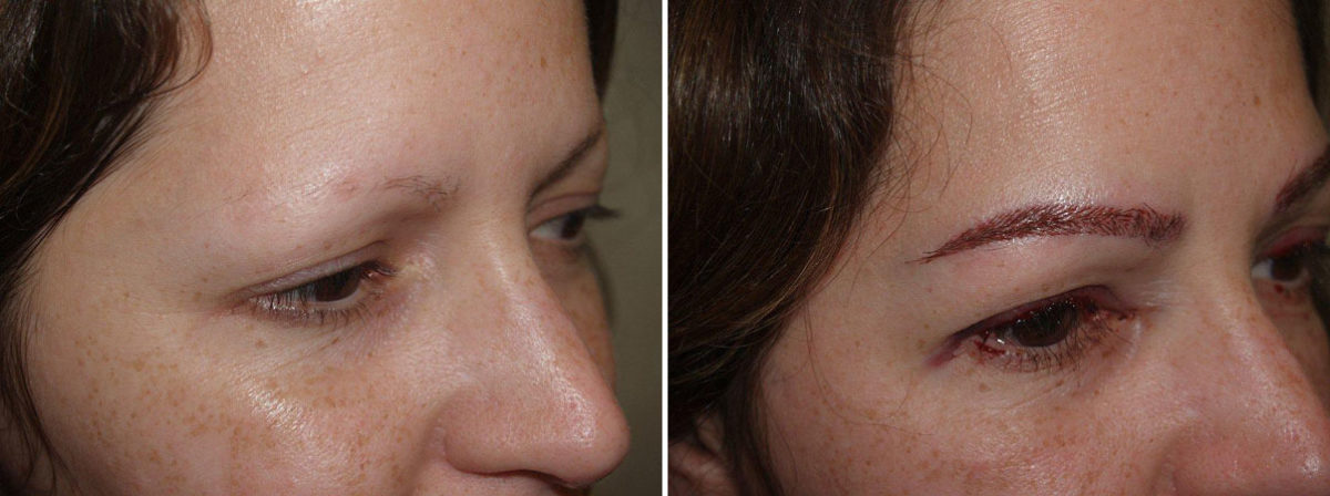 Eyebrow Transplantation before and after photos in Miami, FL, Patient 16390