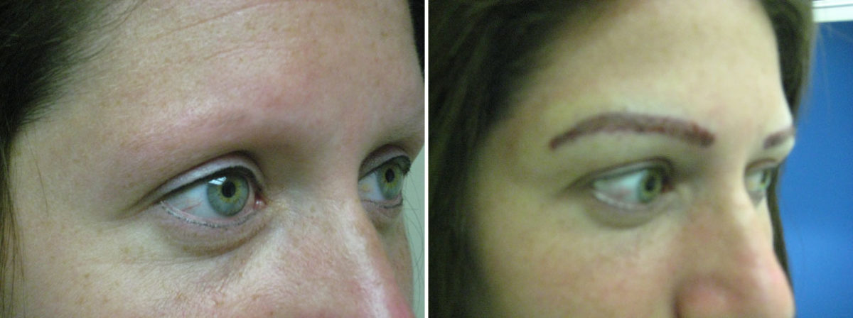 Eyebrow Transplantation before and after photos in Miami, FL, Patient 16409