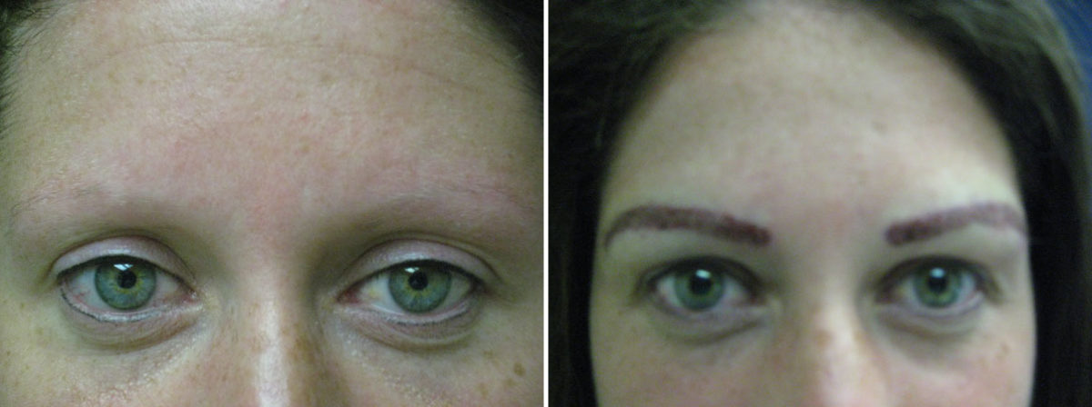 Eyebrow Transplantation before and after photos in Miami, FL, Patient 16409