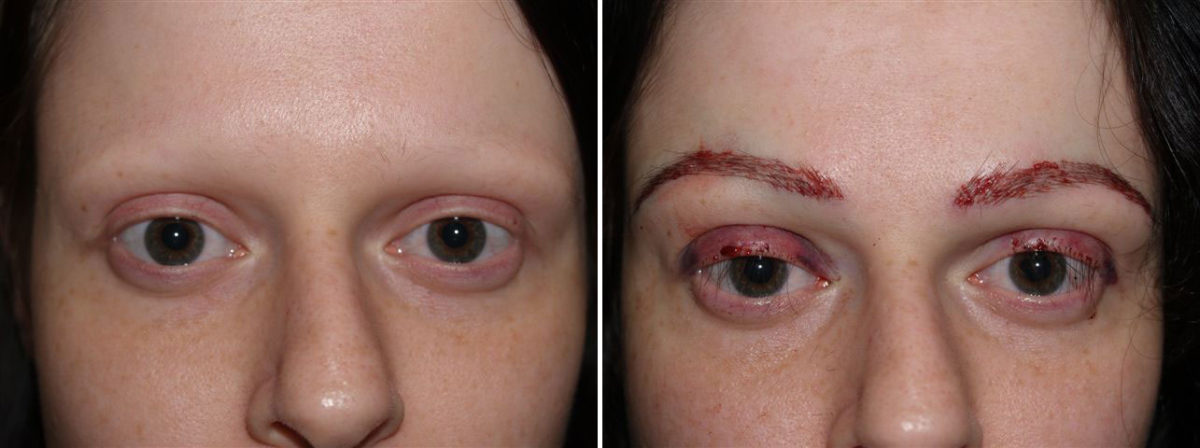 Eyebrow Transplantation before and after photos in Miami, FL, Patient 16707