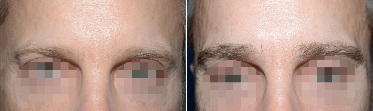Eyebrow Transplantation before and after photos in Miami, FL, Patient 18249