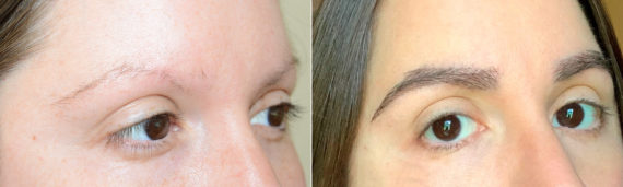 Eyebrow Transplantation before and after photos in Miami, FL, Patient 18271