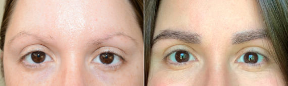 Eyebrow Transplantation before and after photos in Miami, FL, Patient 18271