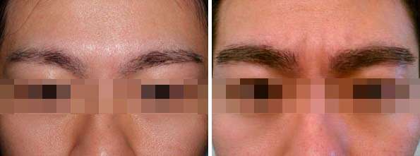 Eyebrow Transplantation before and after photos in Miami, FL, Patient 16594