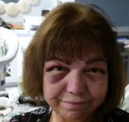 Patient 2, Before Eyebrow Transplants, Miami, FL