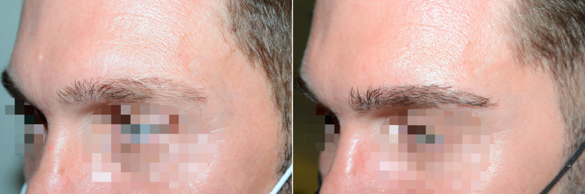 Eyebrow Transplantation before and after photos in Miami, FL, Patient 18465