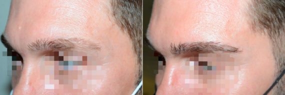 Eyebrow Transplantation before and after photos in Miami, FL, Patient 18465