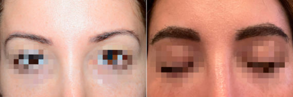 Eyebrow Transplantation before and after photos in Miami, FL, Patient 18473