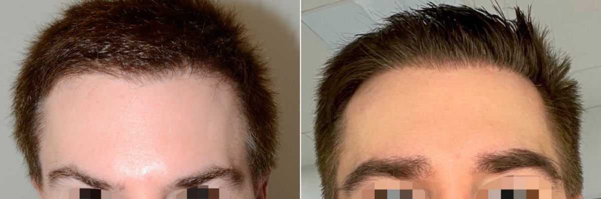 Eyebrow Transplantation before and after photos in Miami, FL, Patient 18495